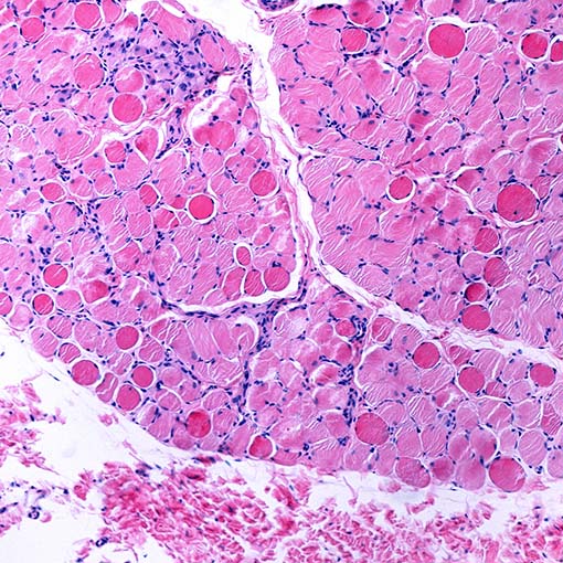 Distrofia Muscular e Desafios de Mobilidade