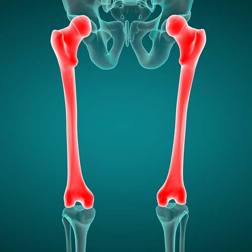 Osteogênese Imperfeita e Problemas de Mobilidade