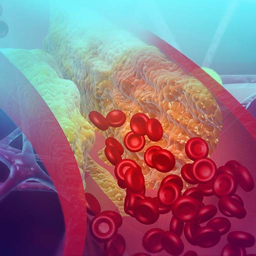 Doença Vascular e Problemas de Mobilidade