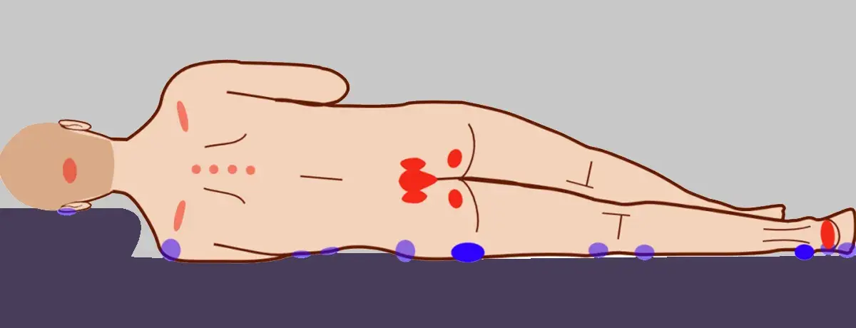 Pressure ulcers associated with immobility